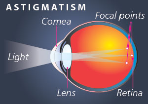 EyAstigmatism