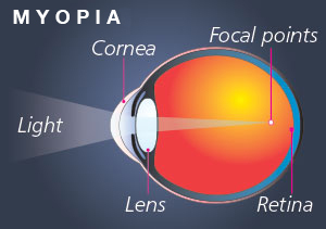 EyMyopia