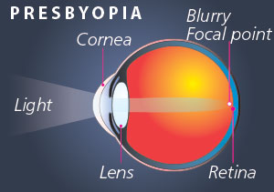 EyPresbyopia