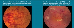 Retinal-Vein-Occlusion-art