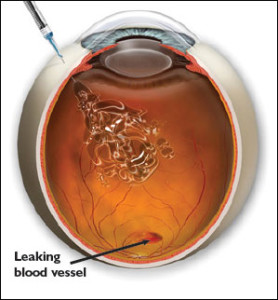 Leaking-blood-vessel