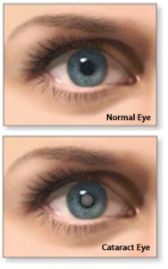 cataract-before-after