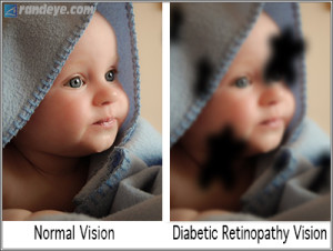 diabetic-retinopathy-vision