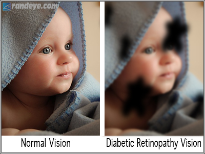 http://www.randeye.com/wp-content/uploads/2014/11/diabetic-retinopathy-vision.jpg