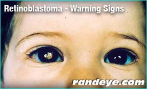 retinoblastoma-signs