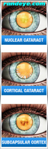 types-of-cataract