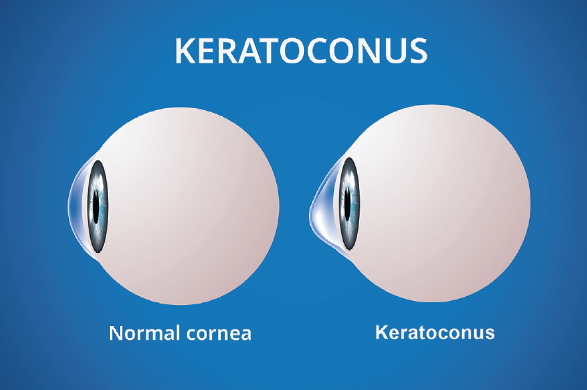 normal-cornea-vs-keratoconus