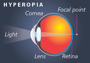 EyHyperopia