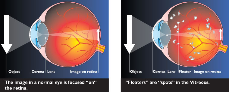 Can eye floaters be a cause of medical alarm?