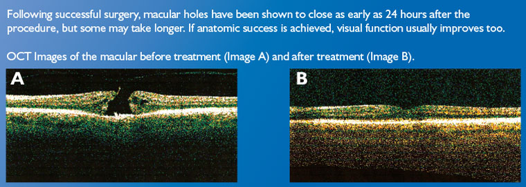 Macular-Hole--Treatment