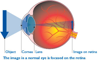 Macular-Hole