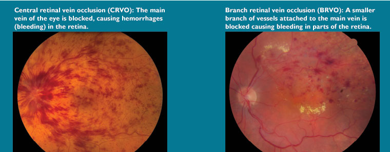 central retinal artery occlusion vs normal