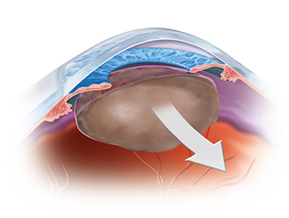 SxCataractRemoval