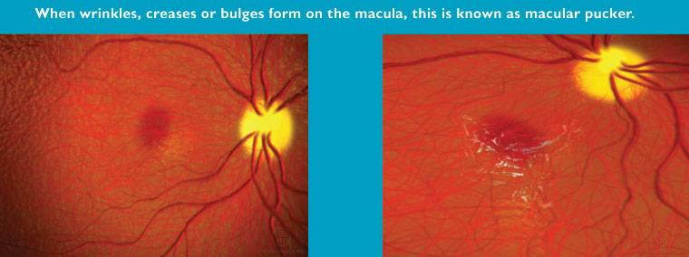 macular-pucker-sample