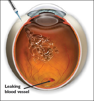 The Making of Medicine  What's the Liquid Inside Your Eyeballs?