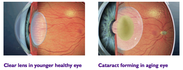 clear-lens-cataract-lens