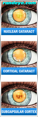 types of cataracts