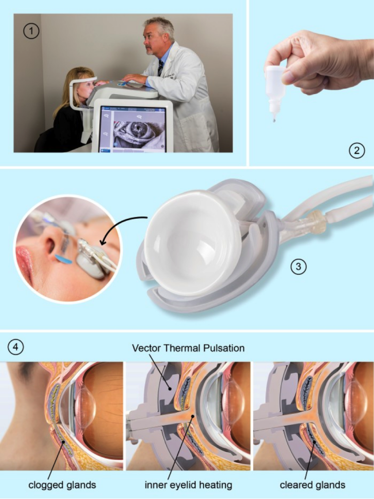 Drye Eye Symptoms